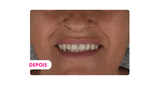 Depois — Resultado real