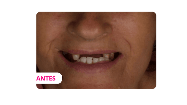 Depois — Resultado real